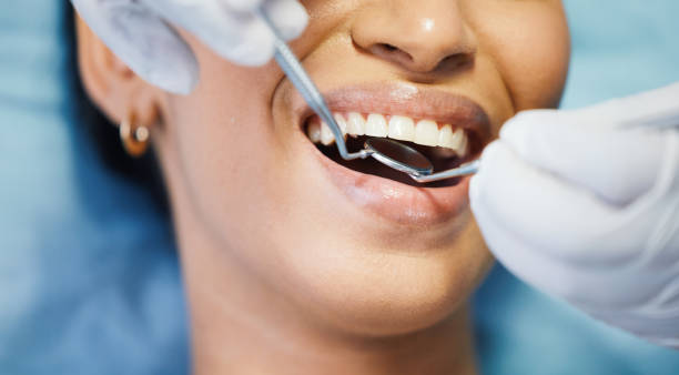 Best Emergency Wisdom Tooth Extraction in Dallas, GA