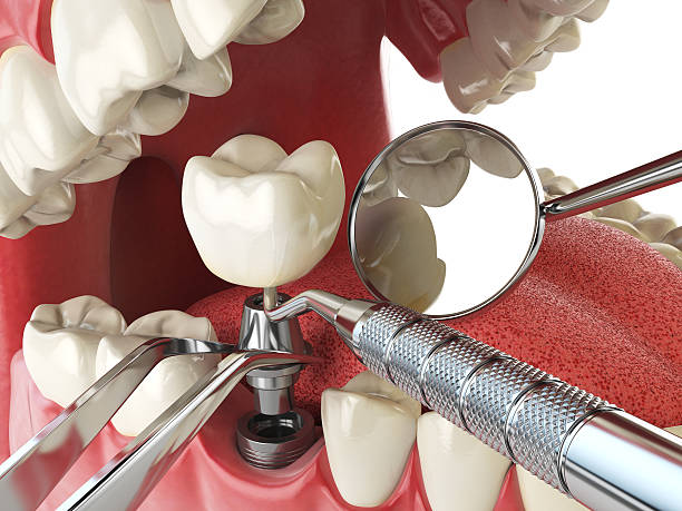 Best Emergency Root Canal Therapy in Dallas, GA